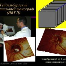 Астахов Ю.С. Ранняя диагностика глаукомы. Доклад. Белые ночи-2011, 01 июня 2011г., Санкт-Петербург, Россия. Astakhov YS Early diagnosis of glaucoma. Академия глаукомы, Academy Glaucoma. Клуб знатоков. Офтальмологический портал Орган зрения www.organum-visus.com