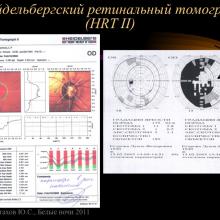 Астахов Ю.С. Ранняя диагностика глаукомы. Доклад. Белые ночи-2011, 01 июня 2011г., Санкт-Петербург, Россия. Astakhov YS Early diagnosis of glaucoma. Академия глаукомы, Academy Glaucoma. Клуб знатоков. Офтальмологический портал Орган зрения www.organum-visus.com