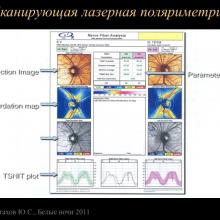 Астахов Ю.С. Ранняя диагностика глаукомы. Доклад. Белые ночи-2011, 01 июня 2011г., Санкт-Петербург, Россия. Astakhov YS Early diagnosis of glaucoma. Академия глаукомы, Academy Glaucoma. Клуб знатоков. Офтальмологический портал Орган зрения www.organum-visus.com