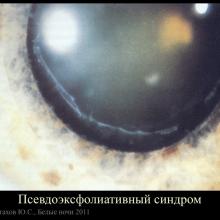Астахов Ю.С. Ранняя диагностика глаукомы. Доклад. Белые ночи-2011, 01 июня 2011г., Санкт-Петербург, Россия. Astakhov YS Early diagnosis of glaucoma. Академия глаукомы, Academy Glaucoma. Клуб знатоков. Офтальмологический портал Орган зрения www.organum-visus.com