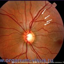 Фокус на диагностику, Diagnosis in focus. Диагностическая ценность осмотра диска зрительного нерва и слоя нервных волокон сетчатки при глаукоме. Профессор Курышева Н.И., г. Москва, Россия. По материалам компании Пфайзер. «АкадемиЯ Глаукомы» Academy Glaucoma инновационный образовательный проект для офтальмологов при поддержке компании Пфайзер. Опубликовано в разделе Клуб знатоков портала Орган зрения www.organum-visus.com, дизайн слайдов подготовил Голубев С.Ю.